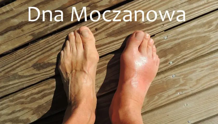 Prawa stopa spuchnięta i zaczerwieniona z powodu ataku dny moczanowej. Lewa stopa wygląda zdrowo.
